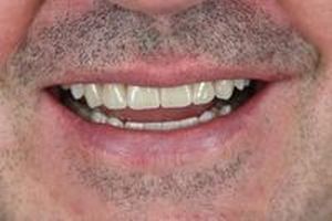 скърцане със зъби - 24518 отстъпки