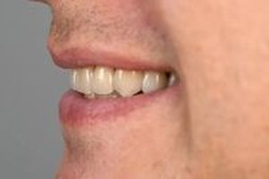 зъбни импланти - 46144 цени